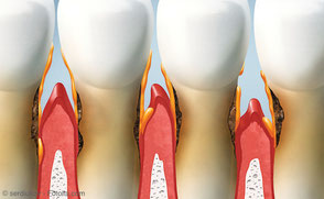 Schnelltest parodontaler Gewebeabbau