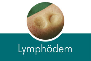 Lymphödem - Druckstellen