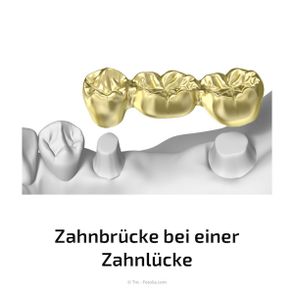 Für Zahnbrücken müssen eigene Zähne abgeschliffen werden. Bei Implantaten ist das nicht erforderlich.