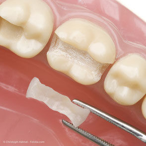 Einlage-Füllungen aus Keramik werden außerhalb des Mundes hergestellt und in einem Stück in den Zahn eingesetzt.
