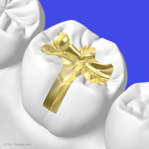 Gold-Inlays haben eine sehr lange Haltbarkeit und hohe Stabilität. Ihre auffällige goldene Farbe wird von manchen Patienten allerdings als störend empfunden.
