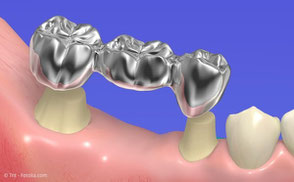 Zahnbrücke: Die Nachbarzähne der Lücke müssen für Kronen beschliffen werden.
