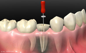 Wurzelbehandlung zum Erhalt eigener Zähne: Erspart Kosten für Zahnersatz und Implantate.