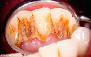Zahnstein, Beläge und entzündetes Zahnfleisch