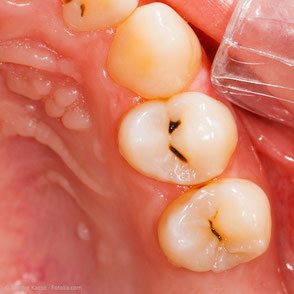 Vorher: Karies (Zahnfäule) in den Grübchen der Kauflächen. Die Karies wirkt von außen oft klein und dehnt sich in der Tiefe aus.