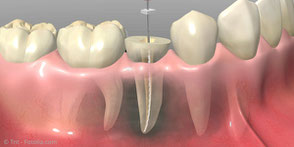 Was ist eine Wurzelbehandlung und wie läuft sie ab?