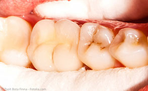 Keramikkrone über dem wurzelbehandelten Zahn