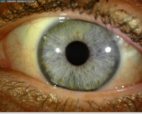 Irisdiagnostik