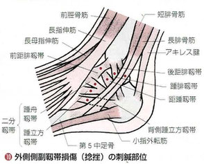 靭帯は軟部組織（ファッシア）です。1mm以下の細い線状の硬結をねらいます。