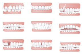 Zahnfehlstellungen für die Gratis-Zahnspange - IOTN Einstufung