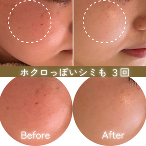 シミケア ビフォーアフター ほくろっぽいシミも!