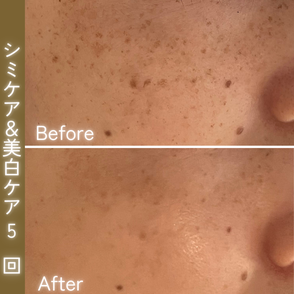 シミケア　ビフォーアフター