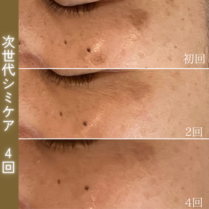 シミケア ビフォーアフター