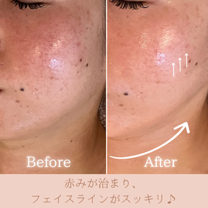 お肌の炎症も 施術1回ビフォーアフター