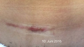 Narbenreduktion Basel, Physiotherapie Basel, Massage Basel, Kaiserschnitt Basel, Verbesserung von Narben, Physiotherapeut Basel, Osteopathie Basel, Dorn-Therapie, Naturheilkunde Basel