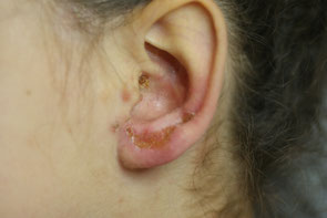photo d eczema atopique de l oreille