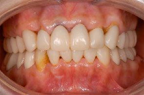 治療中のプロビジョナル・レストレーション