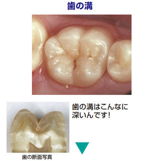 八戸市の歯医者くぼた歯科医院シーラント