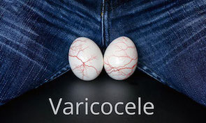 varicocele