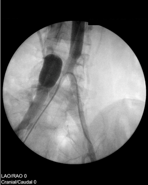 Röntgenaufnahme einer Stop-Flow-Infusion im Rahmen der EISLI-Methode zur regionalen Chemotherapie eines Osteosarkoms am Femur.