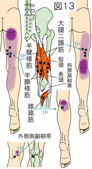 ハムストリングス・膝窩筋・外側側副靭帯トリガーポイントによる大腿・膝・下腿の痛み