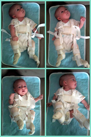 Le Harnais De Pavlick Site De Luxation De Hanche