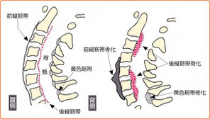 後縦靭帯骨化症,前縦靭帯骨化症,黄色靭帯骨化症