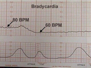 BRADICARDIA FETAL