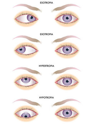 Strabismus. Natural eyesight improvement. Alternative to glasses. Pinhole glasses. Bates Method Teacher. Bates Method exercises. How to improve my eyesight naturally.