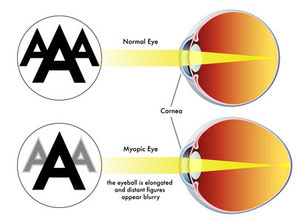 Myopia. Natural eyesight improvement. Alternative to glasses. Pinhole glasses. Bates Method Teacher. Bates Method exercises. How to improve my eyesight naturally.