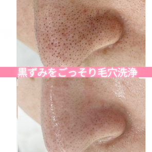 ハイドラフェイシャル　毛穴の黒ずみケア　ビフォーアフター