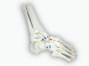 Clubfoot, functional bone model