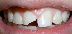 Dental Emergency broken tooth