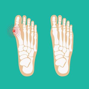 Hallux valgus o juanete