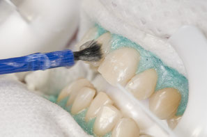Abb. 2: Mehrmaliges Auftragen des Bleich-Gels auf die Zähne für jeweils 20 Minuten (Foto: proDente e.V.)