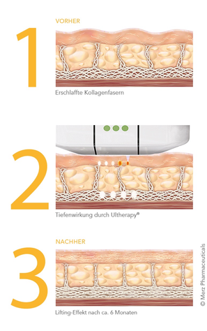 Wirkungsweise Ultherapy Prime