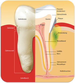 Wie Parodontitis entsteht (© proDente e.V.)