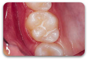 Die feinen Grübchen in den Backenzähnen sind besonders anfällig für Karies. Deshalb werden Sie bei der Fissurenversiegelung mit einem speziellen Kunststoff geschützt. (© Doc S)Dr. Udo Goedecke. Zahnarzt in Osnabrück