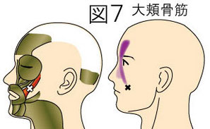 大頬骨筋トリガーポイントによる頭痛と顔の痛み