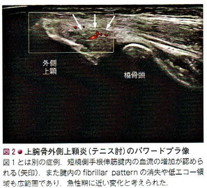 上腕骨外側上顆炎（テニス肘）のパワードプラ像