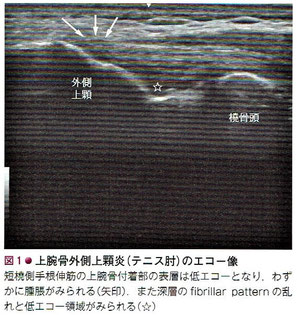 上腕骨外側上顆炎（テニス肘）のエコー画像