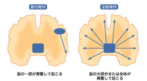 Image:てんかんinfo