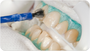 Auftragen des Bleaching-Gels (© Foto: Initiative pro Dente e.V.)