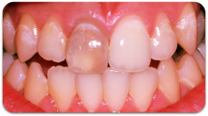 Einzelner dunkler Zahn mit abgestorbenem Zahnnerv (© Foto: Doc R)