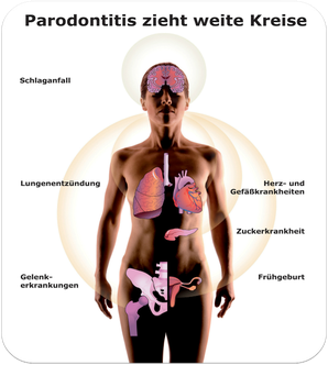Gesundheitsgefahren durch Parodontose (© proDente e.V.)