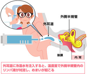カロリック検査