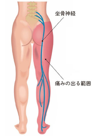 坐骨神経の走行および疼痛範囲図