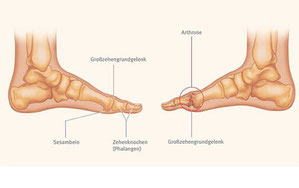 Hallux rigidus