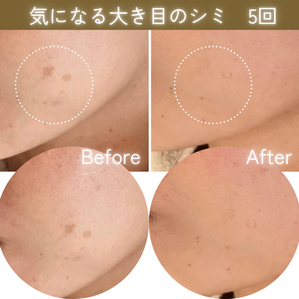 シミケア　ビフォーアフター
