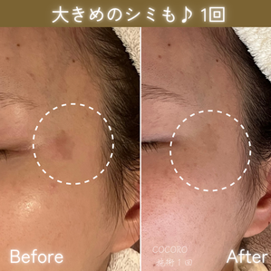 シミケア　ビフォーアフター